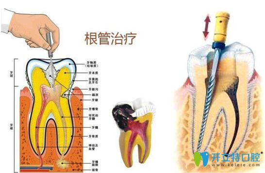 南昌安植雅口腔洪偉偉醫(yī)生介紹顯微根管治療優(yōu)勢