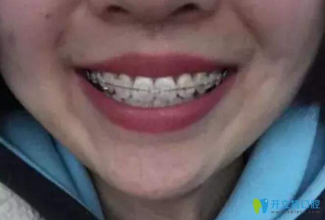 杭州艾芳口腔牙齒矯正排齊過程