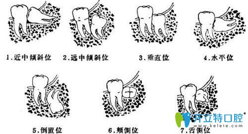 阻生牙的分類