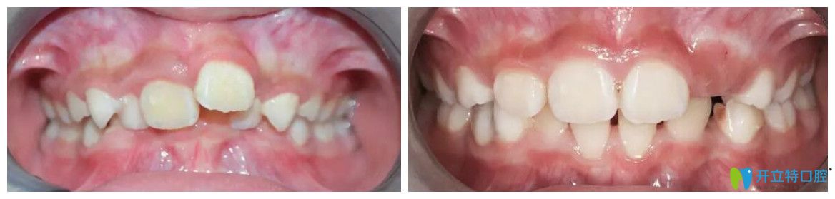 楊素兒童mrc矯正深覆合案例效果對(duì)比圖