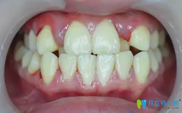 在南陽康澤口腔矯正前的牙齒照片