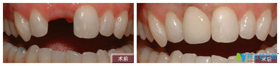 好佰年口腔孫成偉單顆牙即刻種植案例