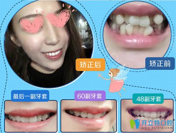 西安壹加壹牙科成人牙齒擁擠矯正前后對(duì)比照
