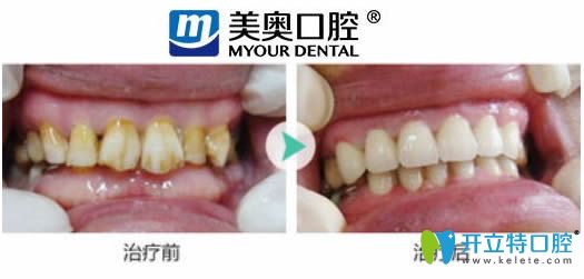 杭州美奧口腔牙齒美白前后對(duì)比效果圖