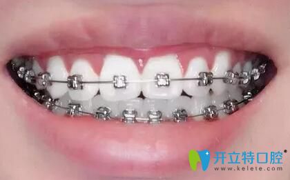 我在重慶鵬博口腔做牙齒矯正16個月 我在重慶鵬博口腔做牙齒矯正16個月