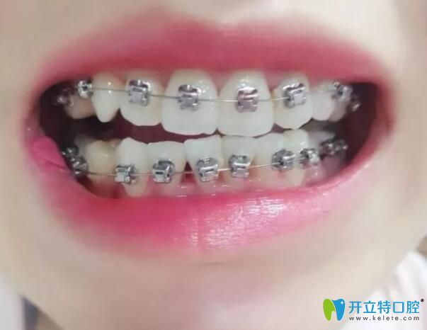 江會(huì)昇牙齒矯正1個(gè)月變化圖