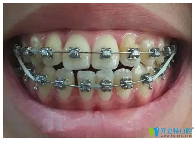 我在鵬博口腔做牙齒矯正第10個月 我在鵬博口腔做牙齒矯正第10個月