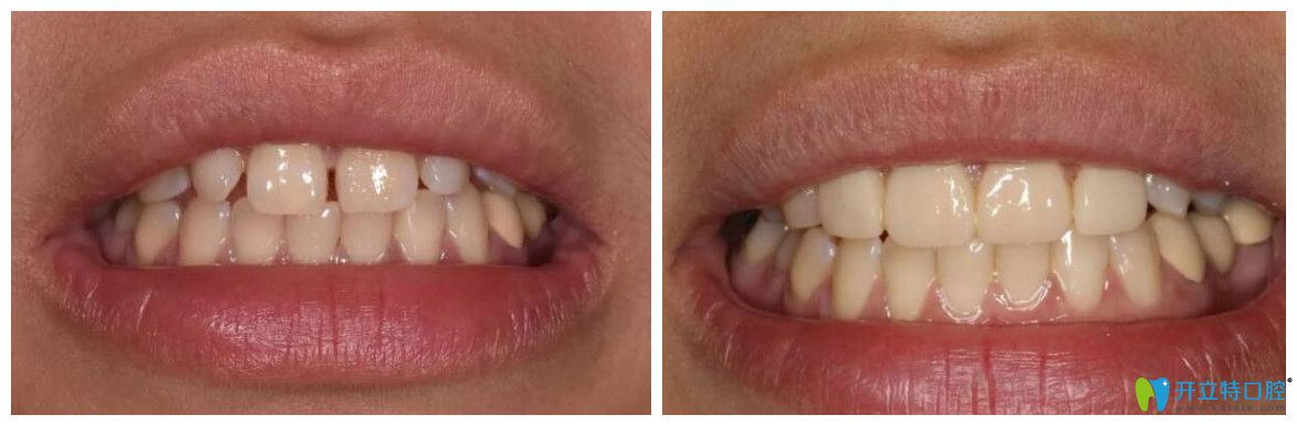 中山禾佳口腔好不好？精品牙科案例公布