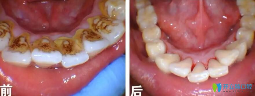 牙齒煙斑冷光美白前后對比圖