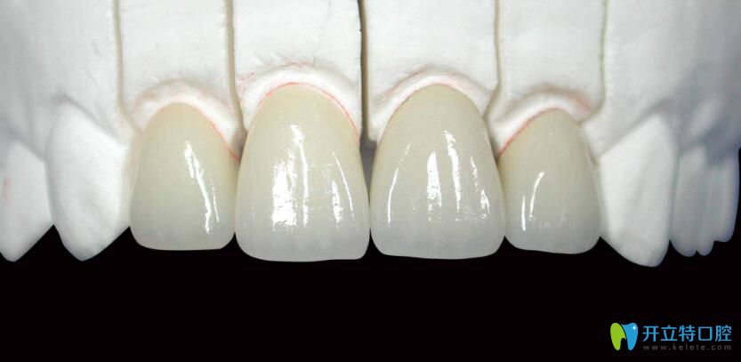 什么是烤瓷牙?烤瓷牙的危害有哪些？中山禾佳口腔醫(yī)生講解