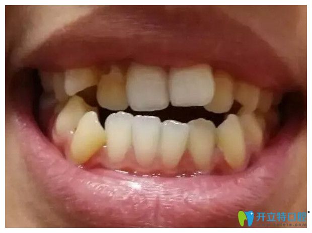 在重慶鵬博口腔做牙齒矯正經(jīng)歷雖辛苦,但是沒(méi)有牙套臉