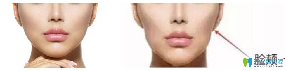 拔了四顆牙臉癟了圖公布，資深牙醫(yī)告訴你該如何避免