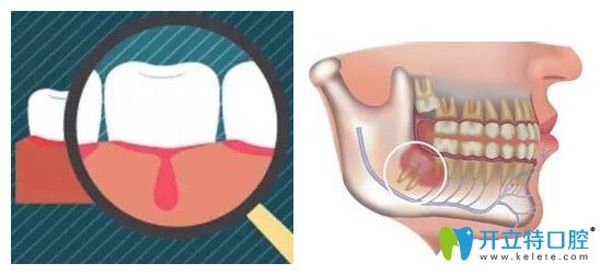牙醫(yī)講出了牙齒冠周炎與牙周炎的區(qū)別