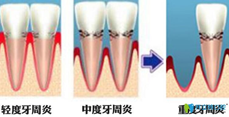 牙周炎圖片