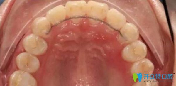 舌側(cè)保持器，它的優(yōu)缺點(diǎn)及佩戴時(shí)間你造嗎