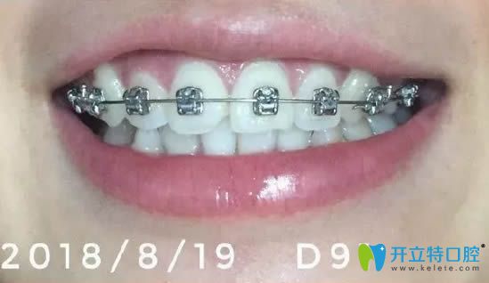 戴牙套已經(jīng)4個(gè)月了
