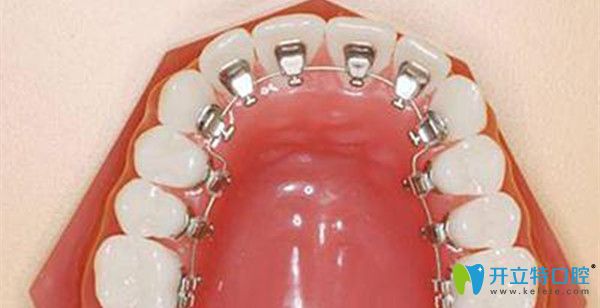 舌側(cè)保持器佩戴時(shí)間