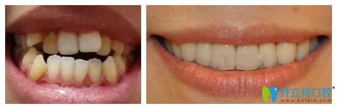 泰州北極星口腔張海瀚隱形牙齒矯正案例