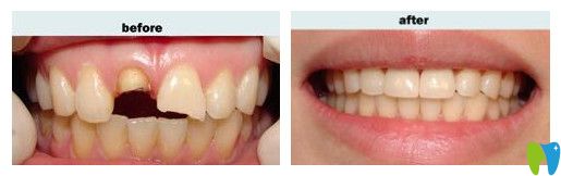重慶鵬博口腔陳亮醫(yī)生前牙缺損修復(fù)效果