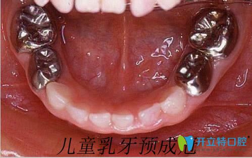 兒童乳牙根管治療后的預(yù)成冠