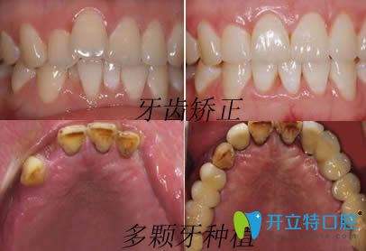 安徽維多利亞口腔牙齒矯正和種植牙效果圖 安徽維多利亞口腔牙齒矯正和種植牙效果圖