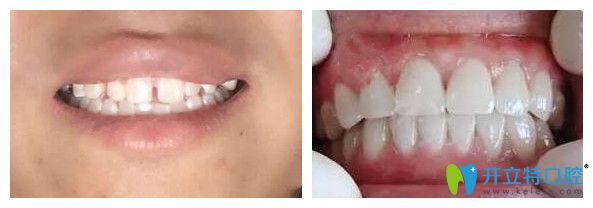 重慶鵬博口腔何冰華醫(yī)生前牙貼面效果圖
