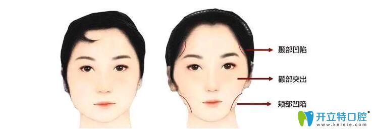 想知道如何避免牙套臉，就得清楚牙套臉是什么