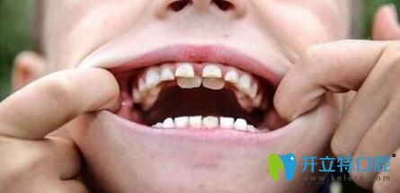 網(wǎng)上說乳牙滯留醫(yī)生不建議拔除是真的嗎？