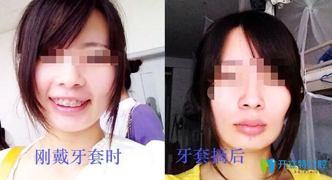 牙套臉會自行恢復(fù)嗎