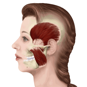 牙套臉是怎么形成的
