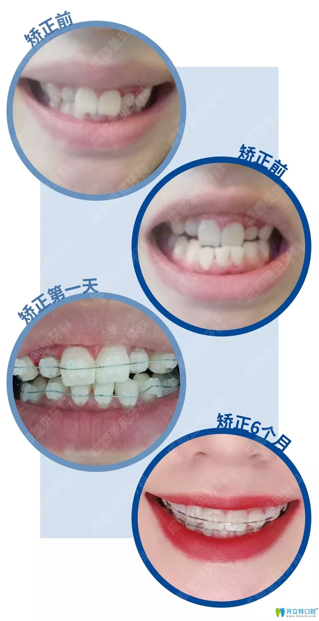圣貝牙科牙齒不齊矯正1-6個月變化過程照片