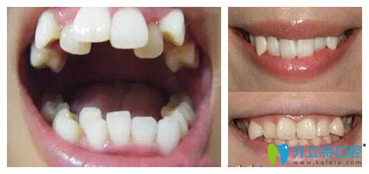 談?wù)劙酥佚X是什么意思以及虎牙和八重牙有區(qū)別嗎？