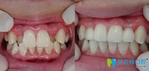 八重齒矯正前后效果
