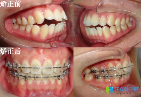沈陽歡樂肖春主任兒童牙齒開合矯正對比效果