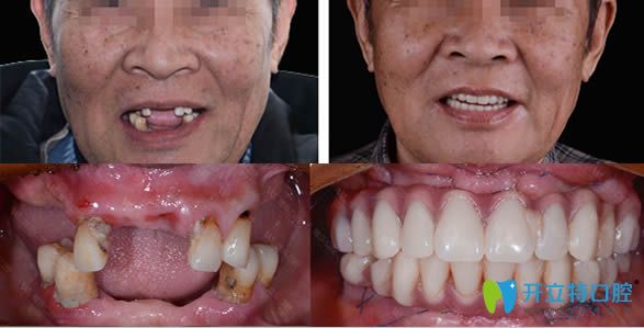 青島維樂口腔種植牙真人案例效果圖