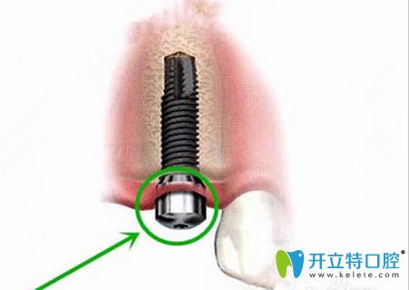 種植牙第4步過程圖