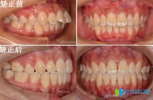 沈陽歡樂口腔肖春醫(yī)生成人深覆蓋矯正前后對比照