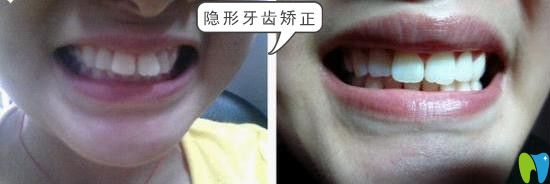 鵬博口腔門(mén)牙突出隱形矯正效果