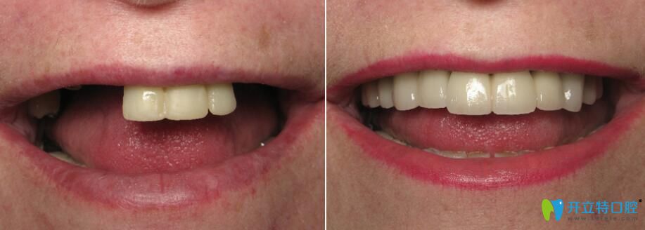 松桃鵬博口腔微創(chuàng)種植牙前后對(duì)比效果