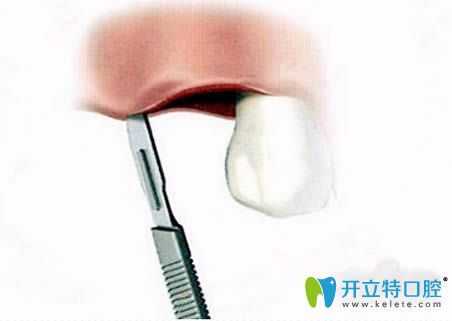 種植牙圖解之<span style=