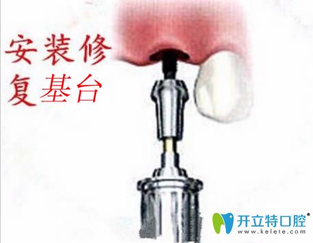 種植牙第5步安裝修復基臺圖