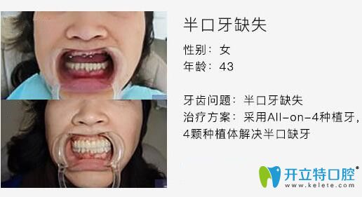 泰州北極星口腔徐雅軒醫(yī)生種植牙案例