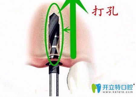 種牙第二步，牙槽骨打孔