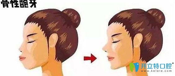 什么是掩飾性正畸及其危害，你了解嗎？