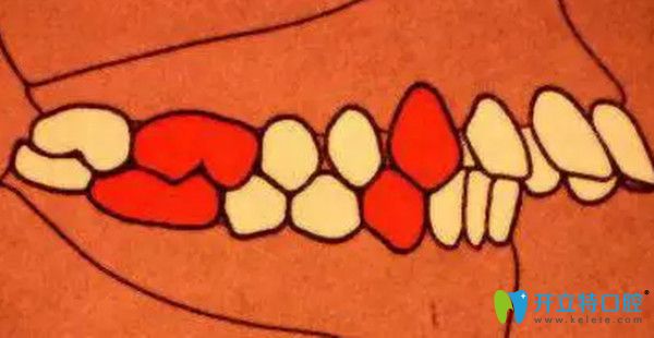 安氏二類錯(cuò)頜  遠(yuǎn)中錯(cuò)頜  頭一個(gè)分類