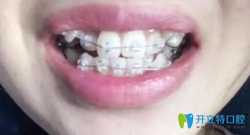 我在鵬博口腔做陶瓷托槽牙齒矯正第3個月 我在鵬博口腔做陶瓷托槽牙齒矯正第3個月