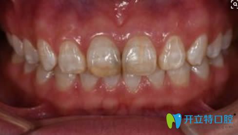 氟斑牙怎么美白?麗江錦美口腔提供一份治療方法及價(jià)格表
