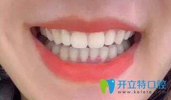 我在鵬博口腔做牙齒矯正15個月效果 我在鵬博口腔做牙齒矯正15個月效果