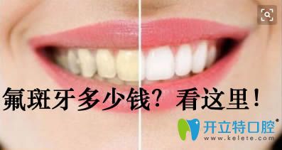 治療氟斑牙的價(jià)格需要多少錢 治療氟斑牙的價(jià)格需要多少錢