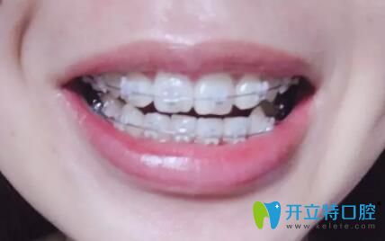我在松桃鵬博口腔做牙齒矯正第9個月 我在松桃鵬博口腔做牙齒矯正第9個月